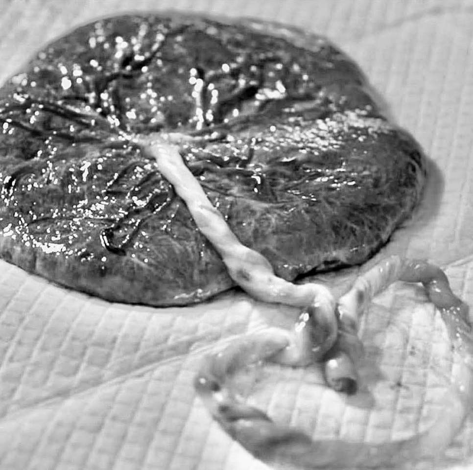 Placenta